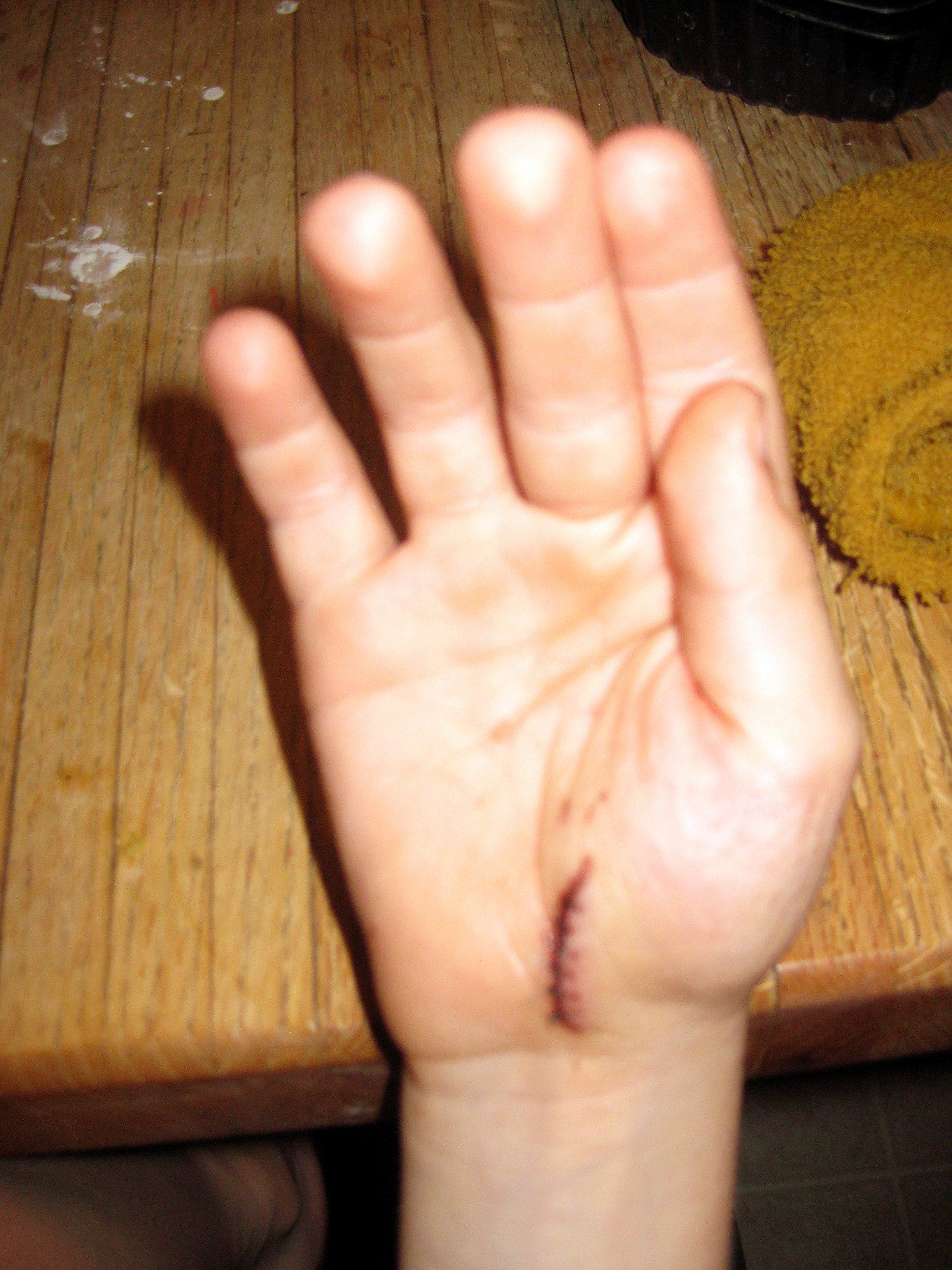 Morgan's hand injury after the garbage-can hide-and-seek accident